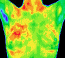 Santa Barbara Breast Thermography