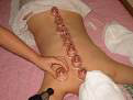 Cupping for Pain Relief and Vibrant Health